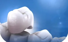 40% Off - High-Quality Dental Crown (Per Tooth)